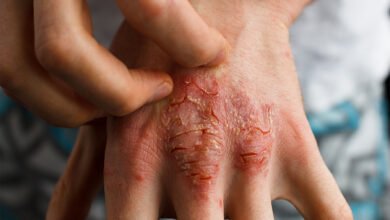 All About Common Skin Disorders