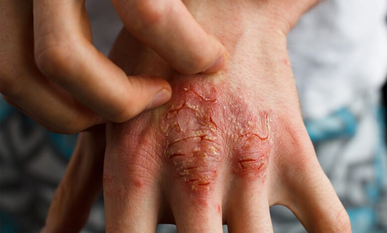 All About Common Skin Disorders