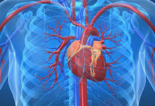 Coronary Calcium Score